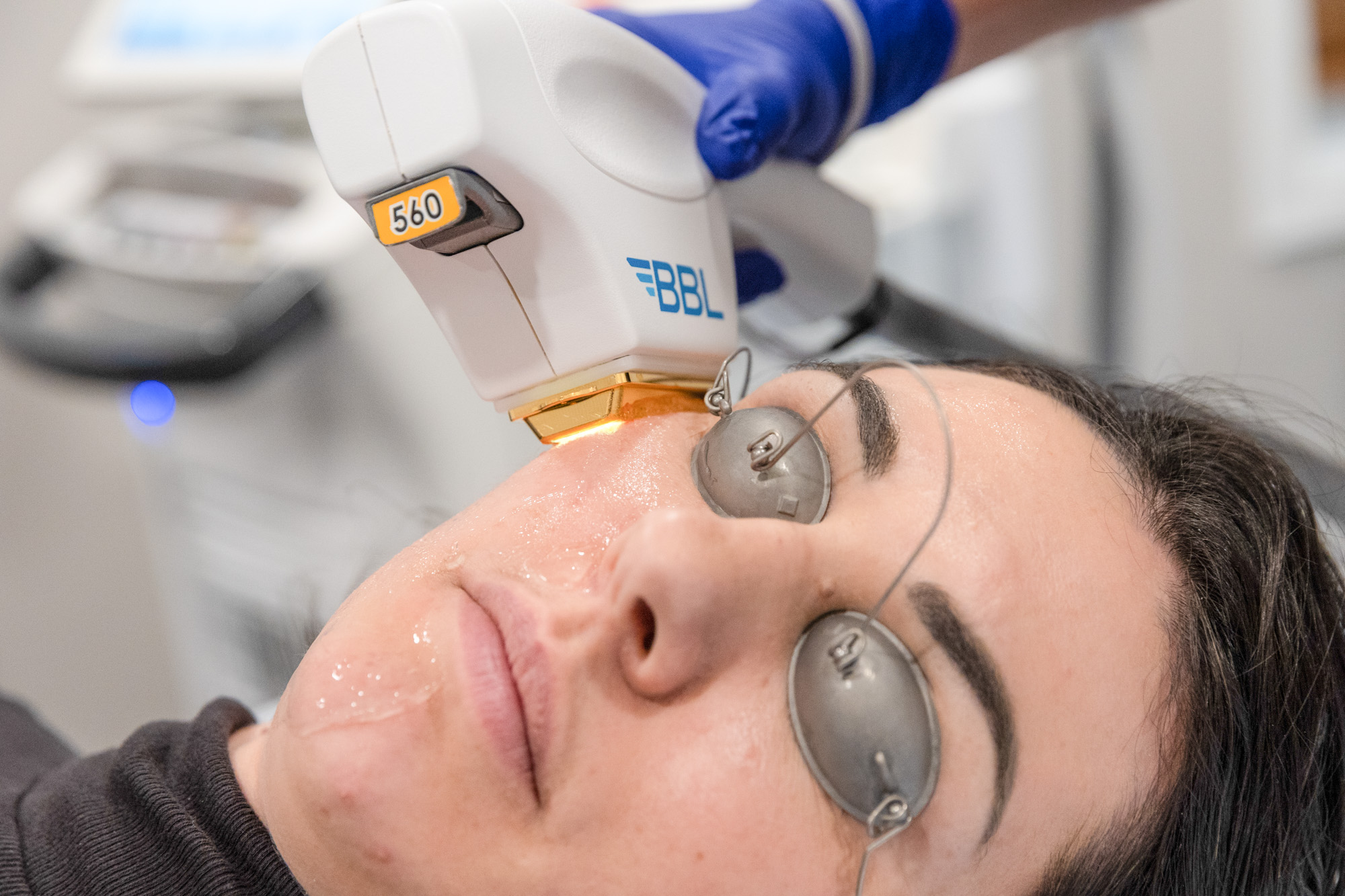 BBL HERO Photofacial